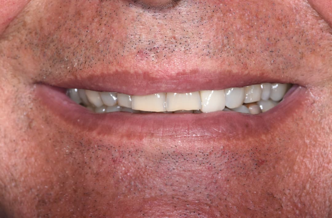 Sauvetage d’une molaire - avant