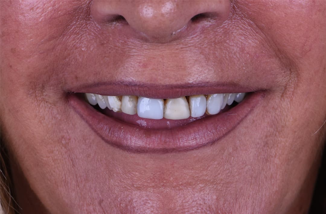 Stabilisation d’une parodontite - avant