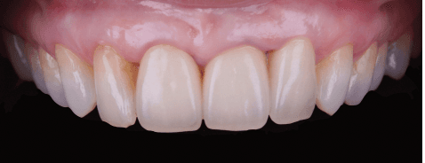 Chirurgie muco-gingivale