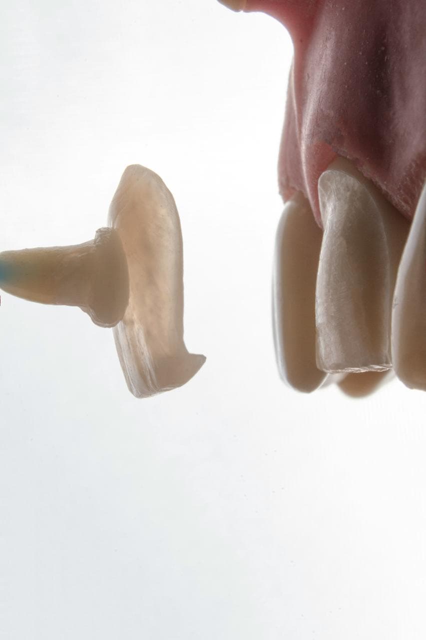 Facettes céramiques sur-mesure