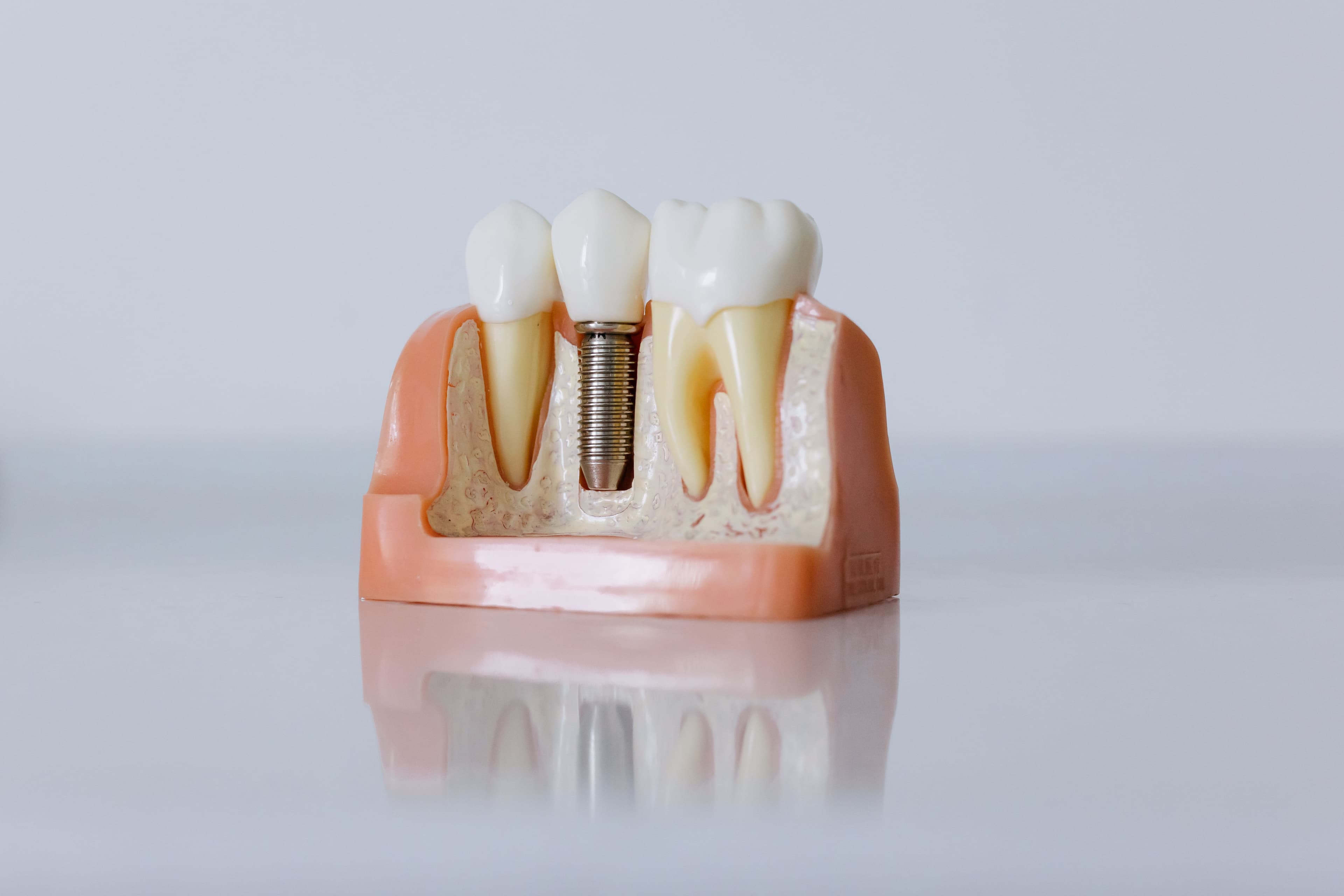 Implants dentaires - Le Lamentin