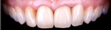 Chirurgie muco-gingivale